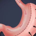 How Gastric Sleeve Revision Can Improve Your Health