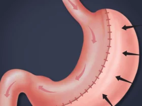 How Gastric Sleeve Revision Can Improve Your Health