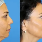 The Cost of Facelift Surgery - Breaking it Down