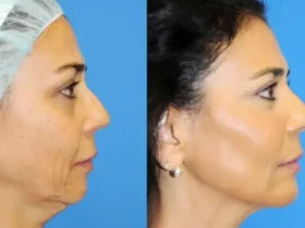 The Cost of Facelift Surgery - Breaking it Down