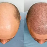 Hair Health And The Role Of Hair Transplantation