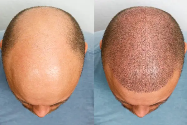 Hair Health And The Role Of Hair Transplantation