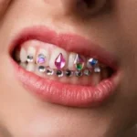 How Long Do Tooth Gems Last? Lifespan, Removal & Replacement Tips