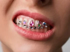 How Long Do Tooth Gems Last? Lifespan, Removal & Replacement Tips